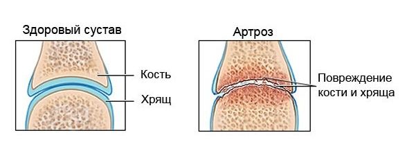 Здоровый сустав и артроз