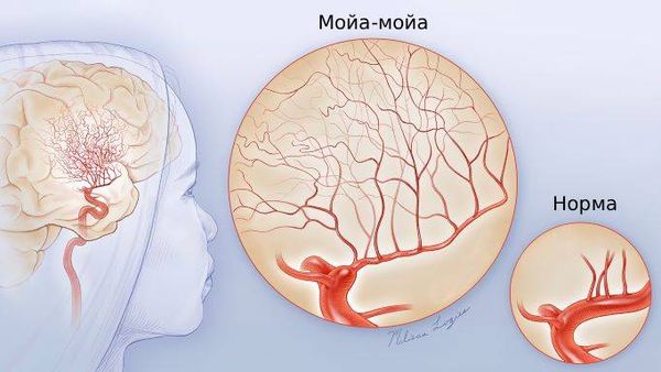Болезнь мойа-мойа