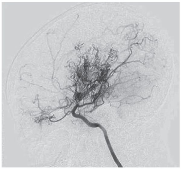 Мойа-мойа на ангиографии [22]