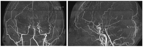 МРТ-картина болезни мойа-мойа [21]