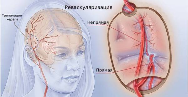 Реваскуляризация