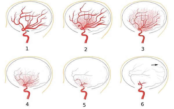 Стадии болезни мойа-мойа