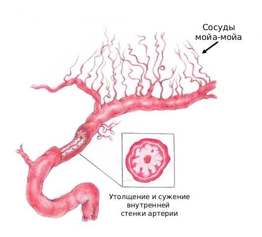 Сужение сонной артерии