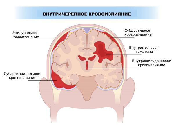 Виды геморрагических нарушений