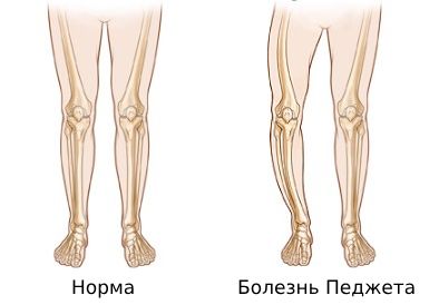 Болезнь Педжета