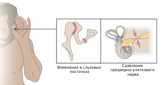 Нарушение слуха при болезни Педжета