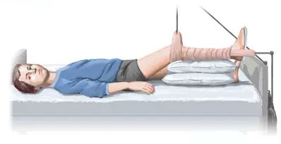 Вытяжение при болезни Пертеса