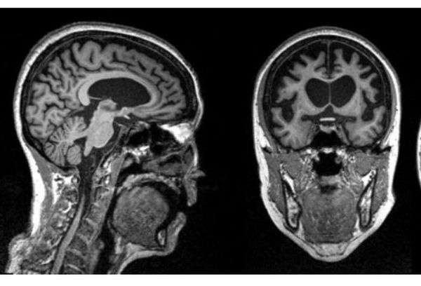 МРТ головного мозга пациентки 50 лет с диагнозом болезнь Пика. На снимках прослеживается выраженная атрофия лобной и височной долей [2]