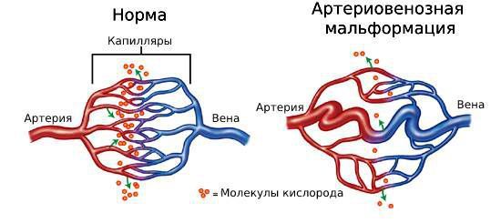 Нормальное соединение артерии и вены и АВМ