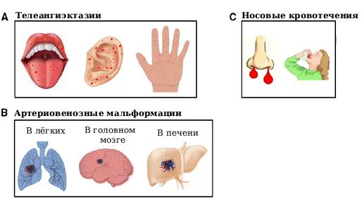 Признаки болезни Рандю — Ослера — Вебера [15]