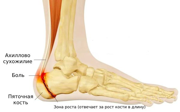 Болезнь Шинца (болезнь Севера)