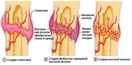 Формирование костной мозоли