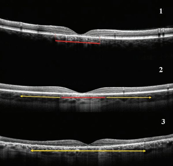 Повреждение слоя IS/OS. 1 — потеря слоя фоторецепторов в макулярной зоне (красный фрагмент); 2 — потеря фоторецепторов с распространением дезорганизации (жёлтая стрелка);  3 — распространённая потеря фоторецепторов [2]