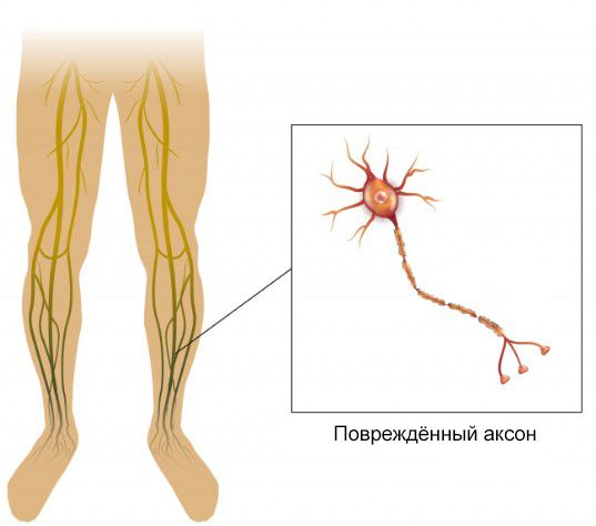 Дегенерация аксона Дегенерация аксона