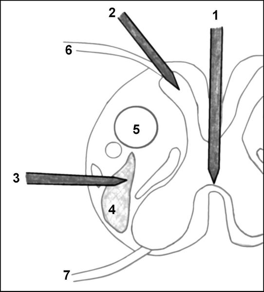 Схема операций по пересечению проводников болевой чувствительности на уровне спинного мозга (на поперечном срезе спинного мозга)