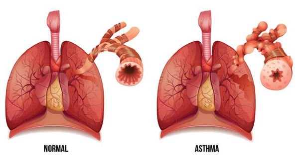 Дыхательные пути в норме и при астме