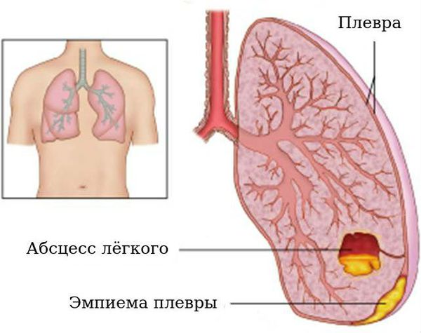 Абсцесс лёгких и эмпиема плевры