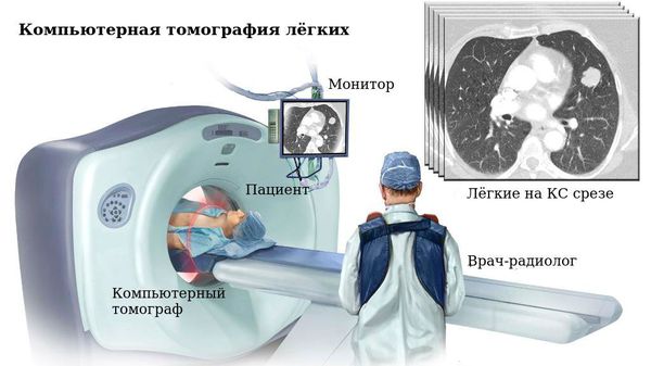 Компьютерная томография лёгких