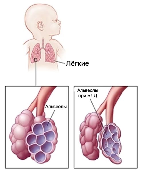 Бронхолёгочная дисплазия Бронхолёгочная дисплазия