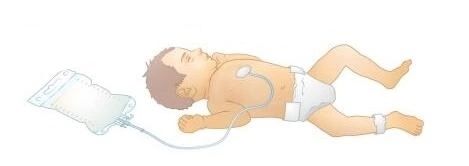 Парентеральное питание Парентеральное питание