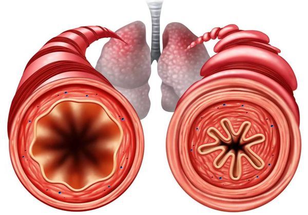 Сужение бронхов Сужение бронхов