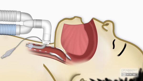 Трахеостомия Трахеостомия