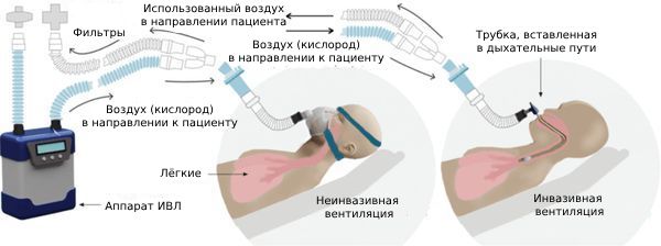 Виды ИВЛ Виды ИВЛ