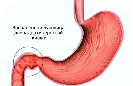 Есакова Е.Ю. Бульбит: причины, симптомы, лечение // www.teledoctor24.ru