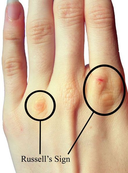 Повреждение кисти при булимии (знак Рассела)