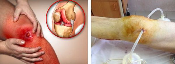 gnoynyy artrit kolennogo sustava s