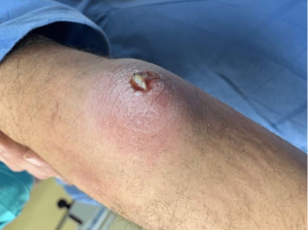 Бурсит локтевого сустава из-за травмы (с повреждением кожи) [7]