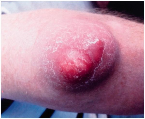 Бурсит локтевого сустава на фоне подагры [2]