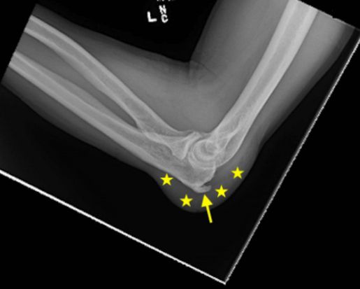 Рентгенограмма  со шпорой локтевого отростка (стрелка) и воспаление бурсы, заполненной жидкостью (звёздочки) [7]