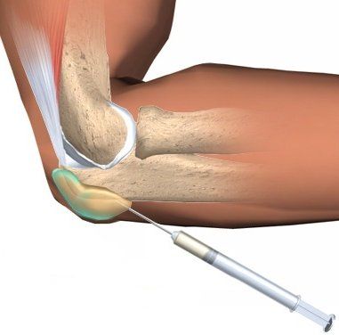 Введение кортикостероидов в бурсу