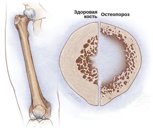 osteoporoz s