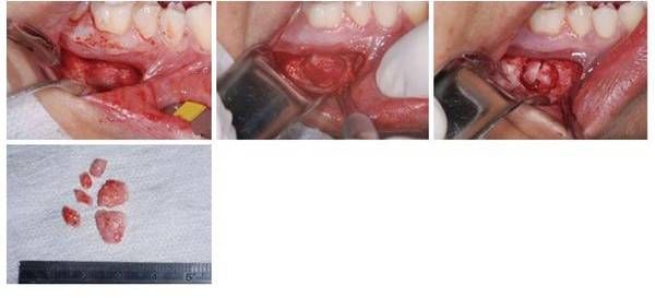 Удаление цементомы [11]
