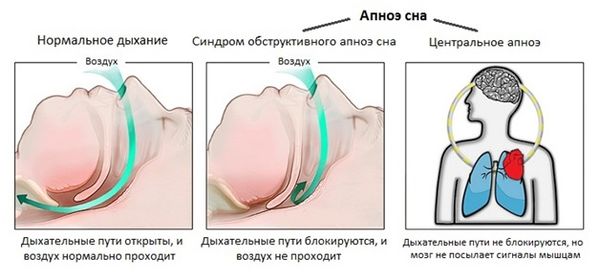 Отличие центрального апноэ сна от обструктивного