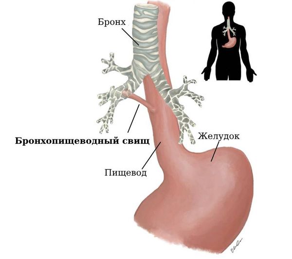 Бронхопищеводный свищ [25]