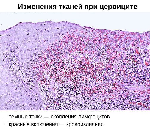 Изменения клеточного строения шейки матки при хроническом цервиците