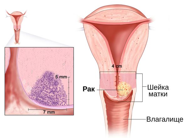 Рак шейки матки