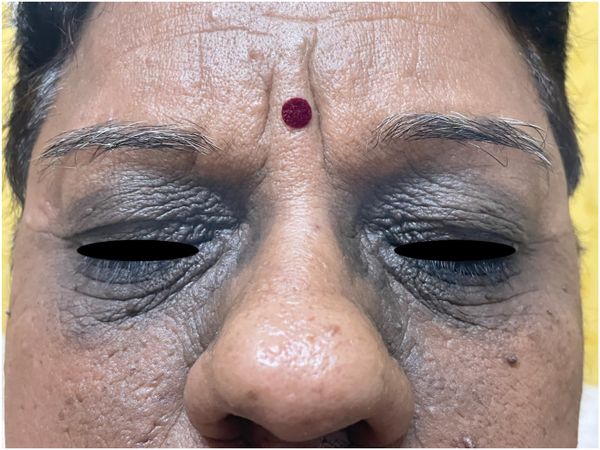 Чёрный акантоз в области глаз [19]