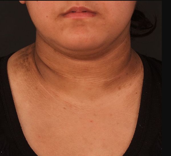 Псевдоакантоз [22]