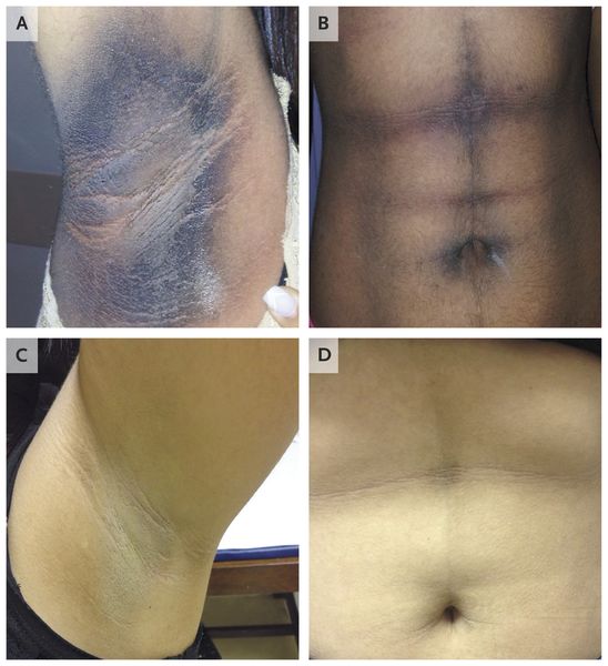 Результат медикаментозного лечения чёрного акантоза при инсулинорезистентности  (сверху — до, снизу — после 6 недель терапии) [24]