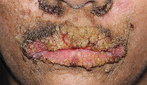 Злокачественный чёрный акантоз [23]