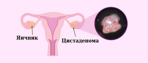 Серозная цистаденома яичника | астонсобытие.рф