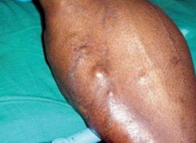 Кисты под кожей [19]