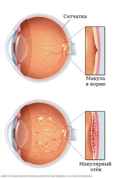 Макулярный отёк [20]