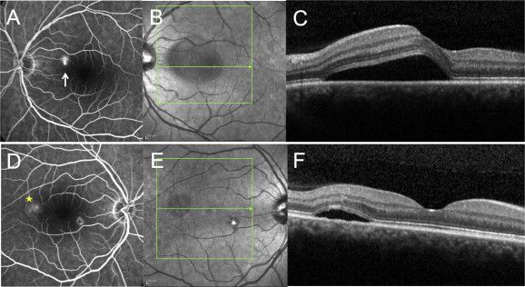 Острая ЦСХРП, видимая при флуоресцентной ангиографии [11]