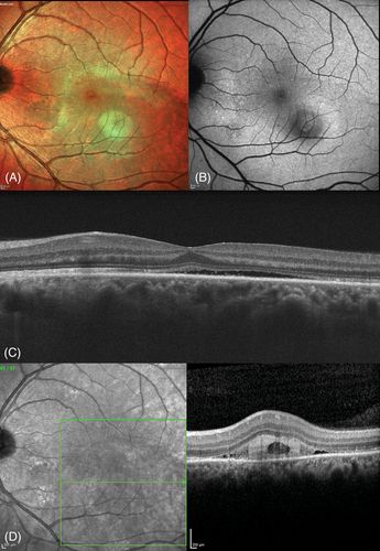 Субретинальный фиброз при центральной серозной хориоретинопатии [2]