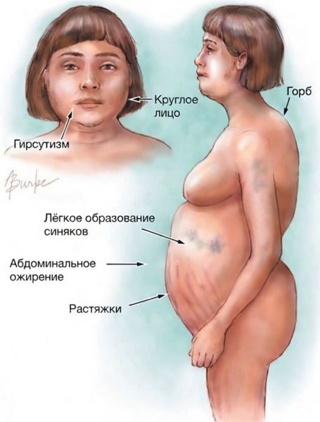 Женщина с симптомами болезни Иценко — Кушинга